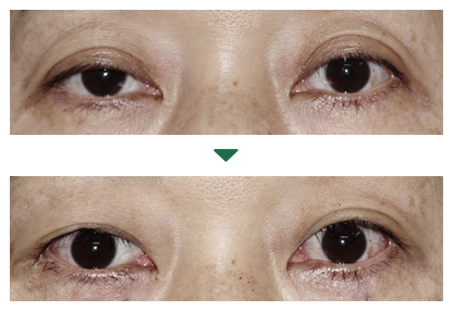 眼瞼下垂の術前術後写真5