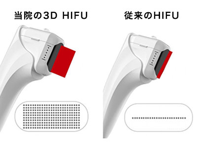 切らないフェイスリフトなら 3dハイフ 湯田眼科美容クリニック Ry グループ