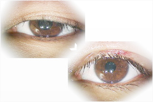 眼瞼下垂の症例写真例