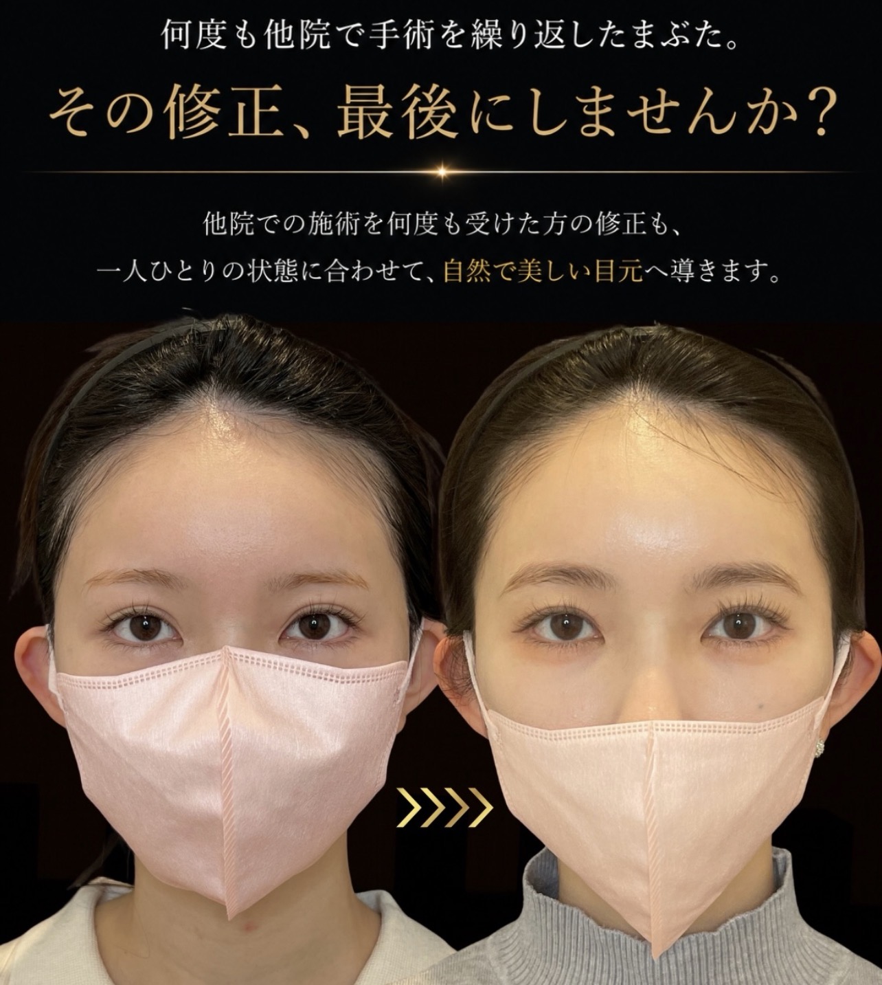二重幅を狭くしたいのメイン症例写真