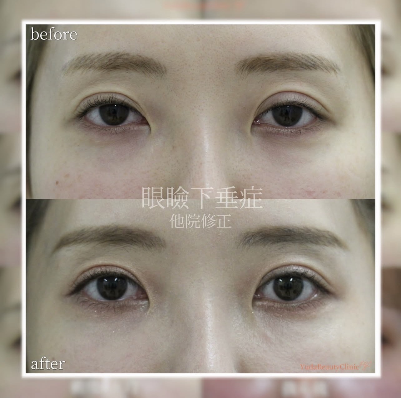 目の開きを改善したい場合のメイン症例写真
