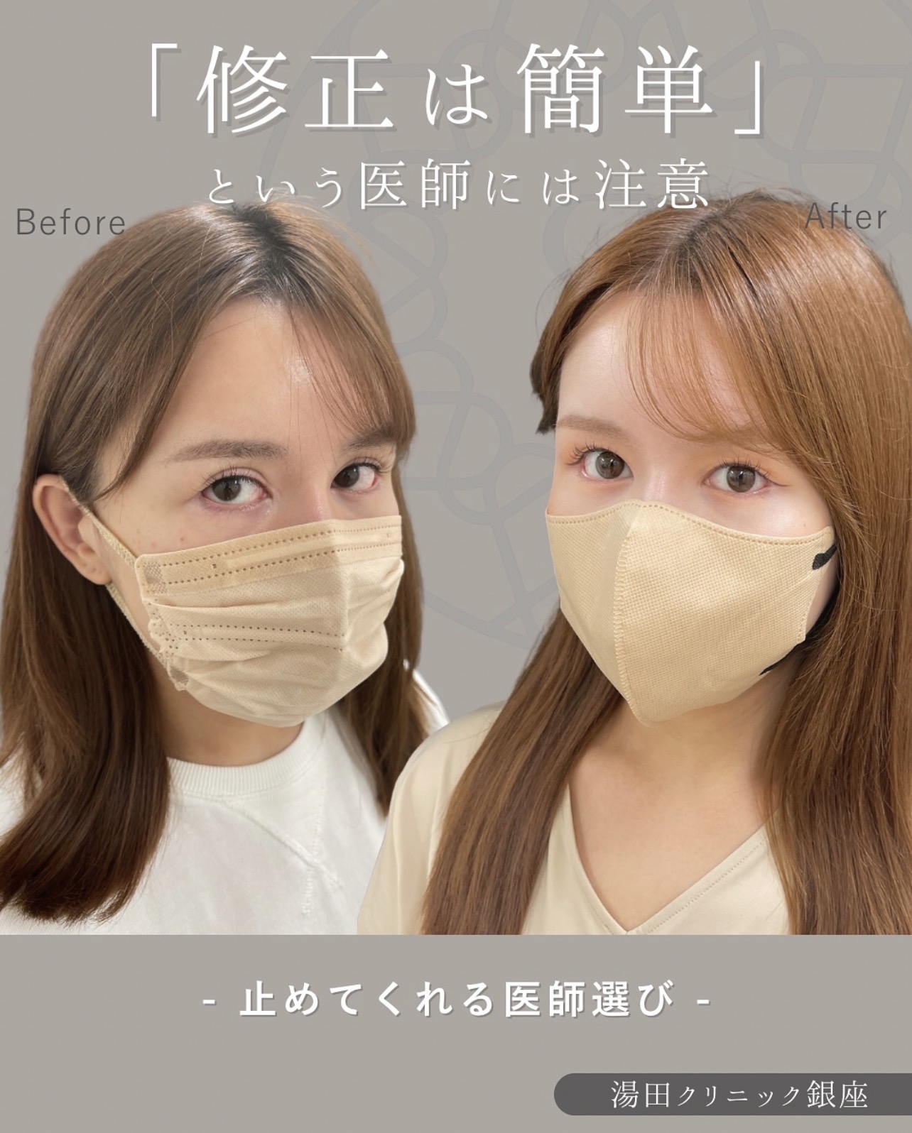 不自然な二重を自然にしたいのメイン症例写真