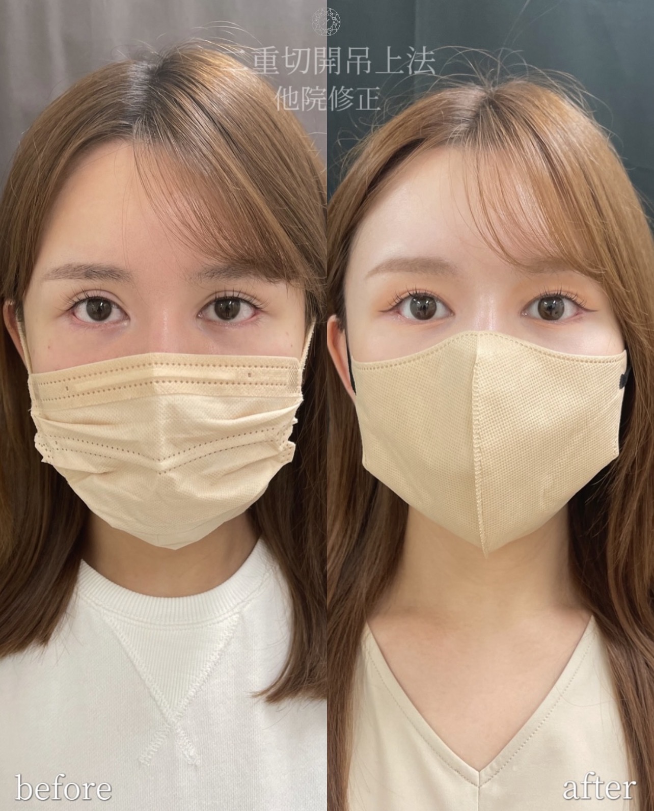 不自然な二重を自然にしたいの比較・経過写真