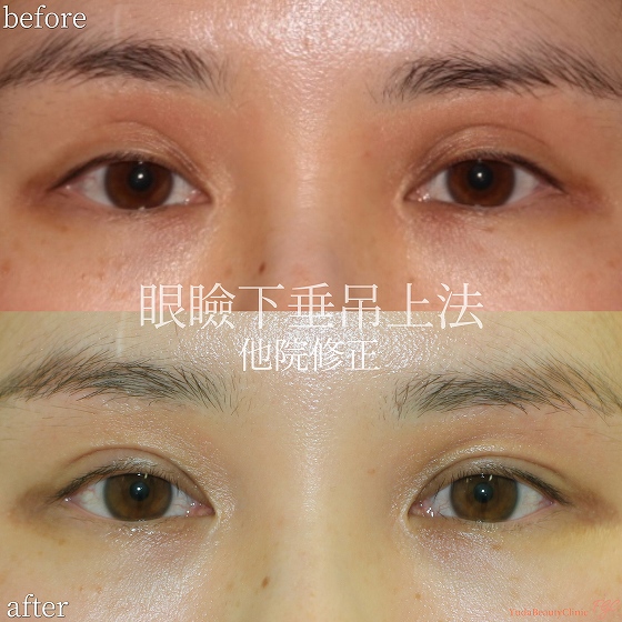 左右差を伴う眼瞼下垂を他院修正した術前術後の比較