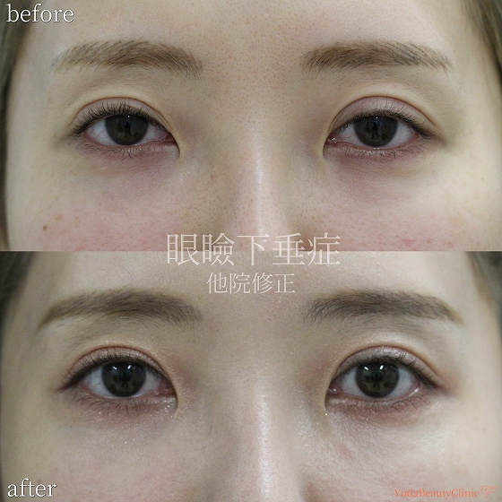 他院眼瞼下垂手術後の目の開きと二重ラインを修正した術前術後の比較