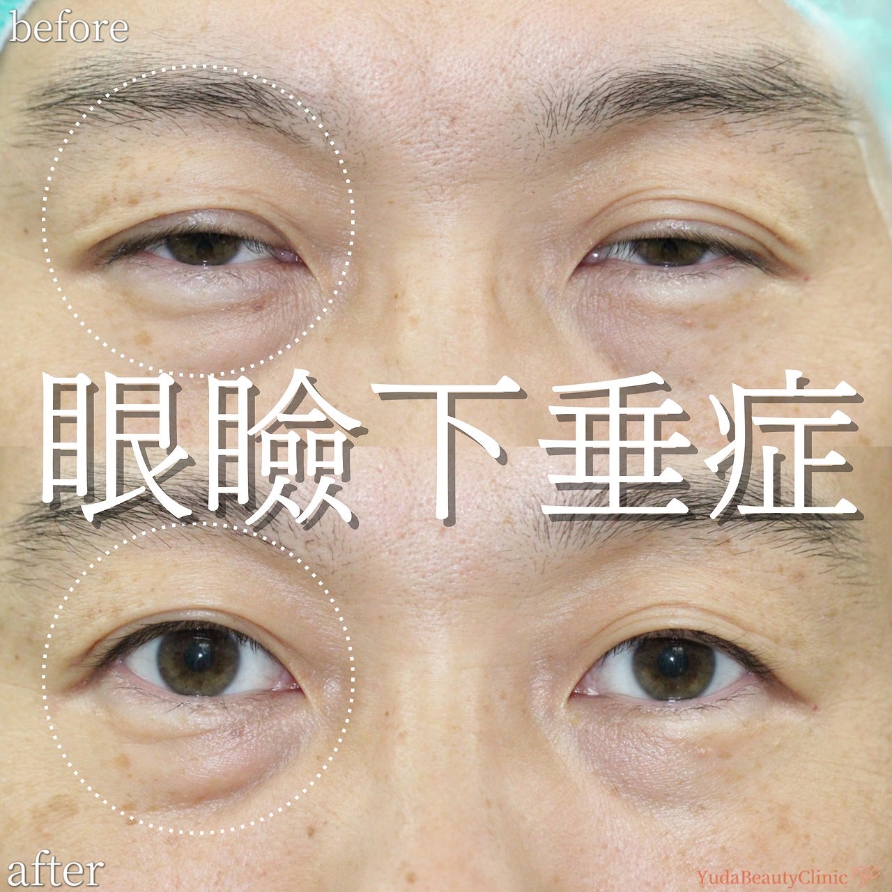 加齢に伴う眼瞼下垂に眼瞼下垂手術を行った術前術後の比較