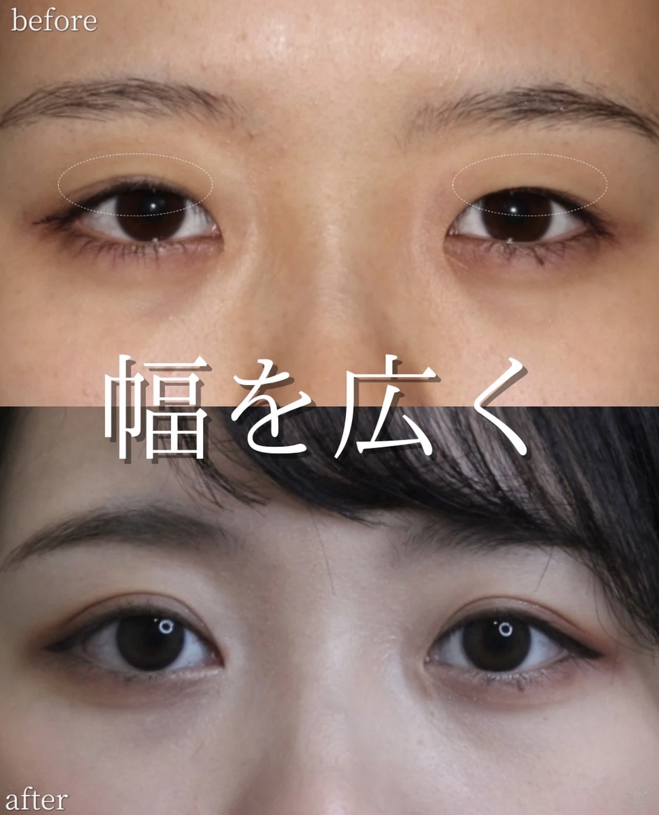 二重埋没法と目頭切開で二重幅を広げた術前と術後1年の症例