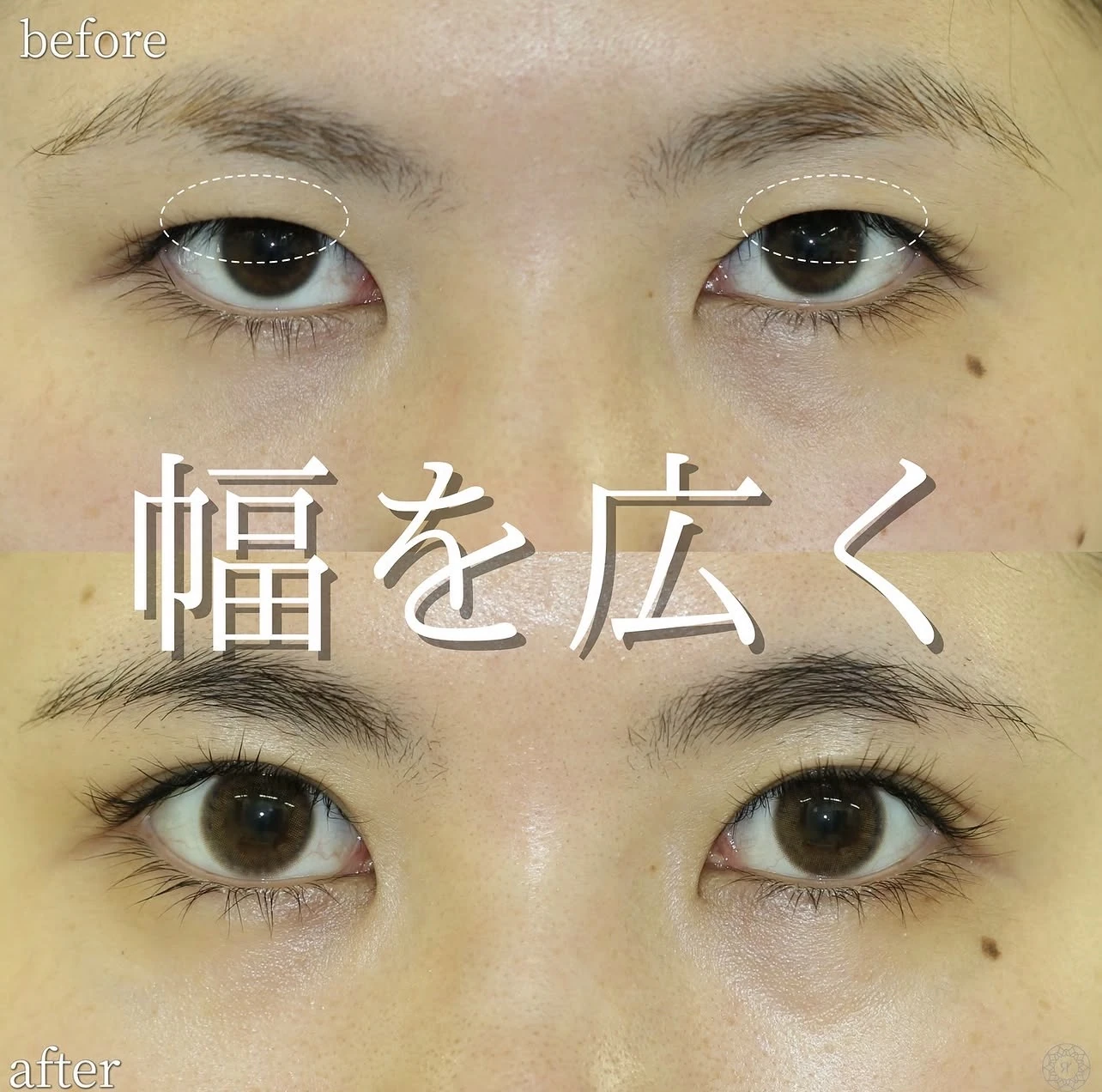 まぶたが厚い方に二重埋没自然癒着法を行った術前と術後1年の症例