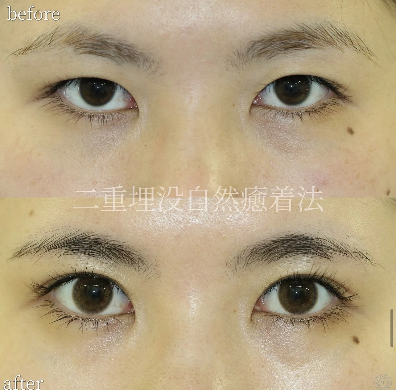 まぶたが厚い方の二重埋没自然癒着法の症例比較