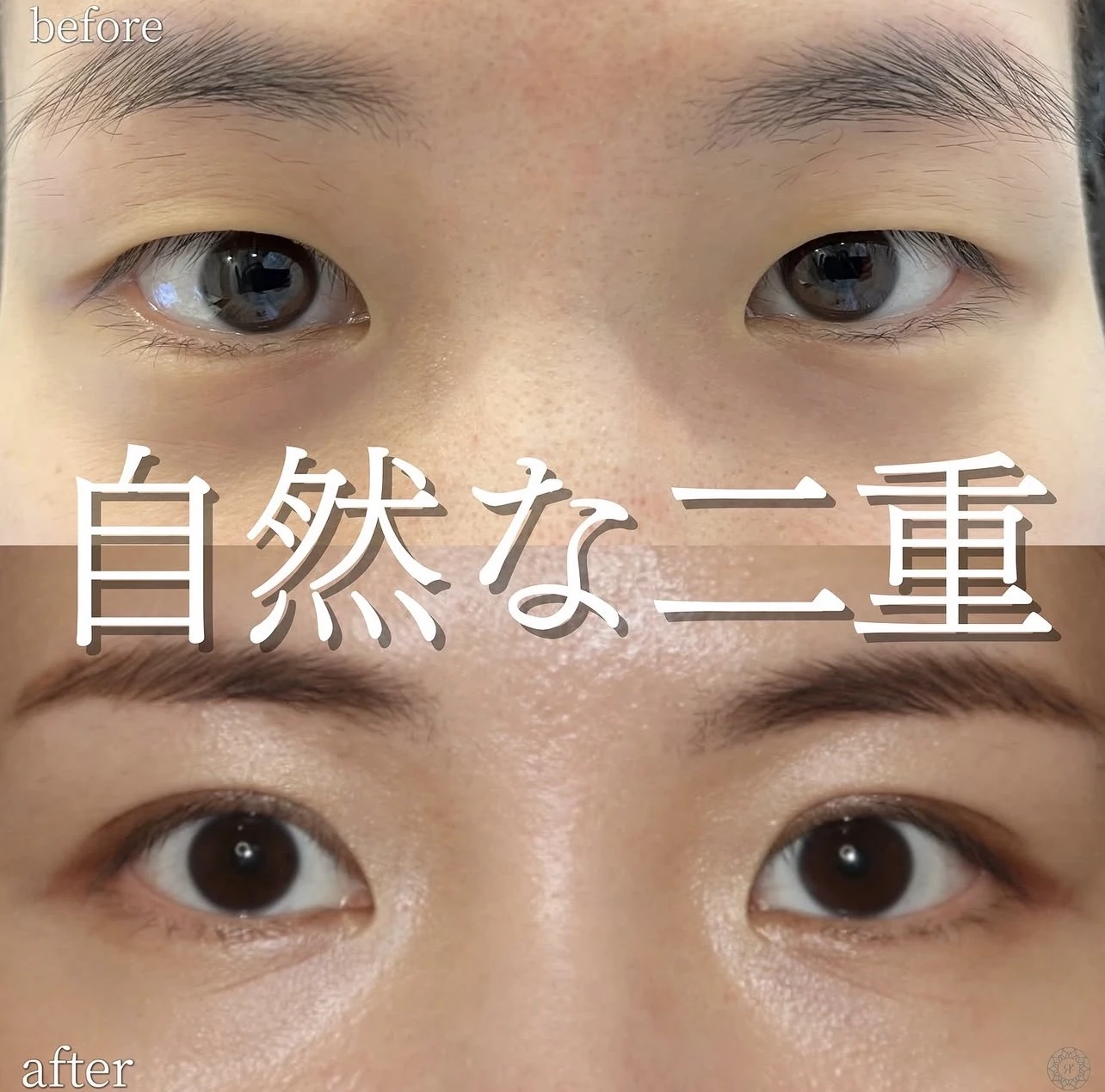 二重埋没法で自然な二重を形成した術前と術後の症例
