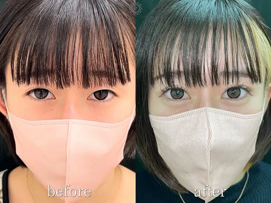二重整形クリニック選びで確認したい症例写真の見方