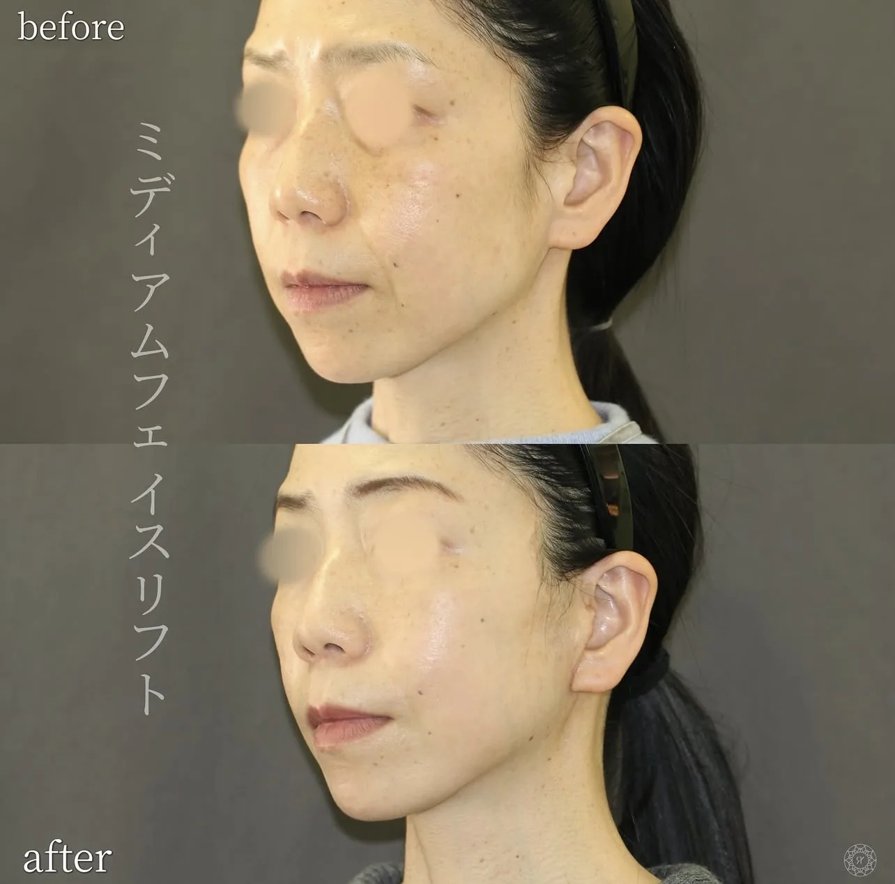 ミディアムフェイスリフト 症例1 Before After