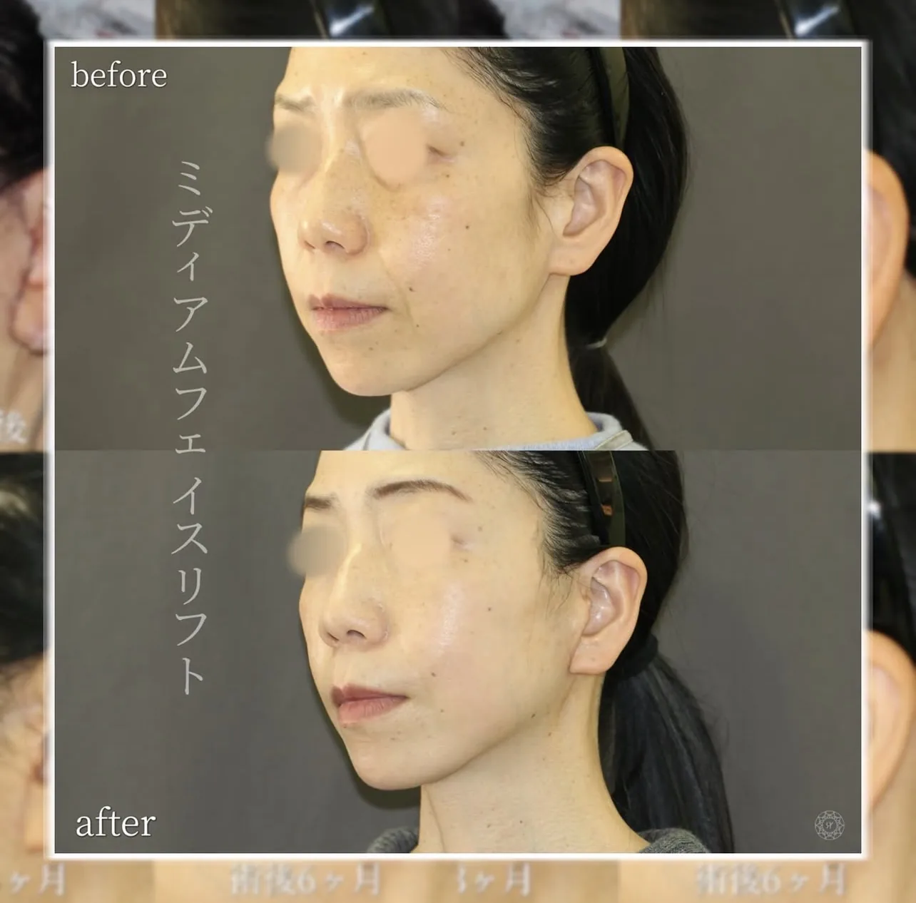 フェイスリフト手術