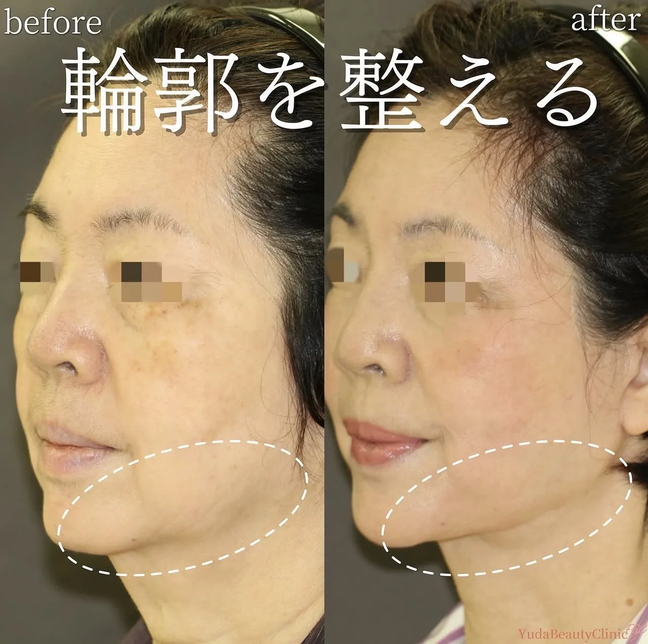 フルフェイスリフト ネックリフト 症例2 Before After