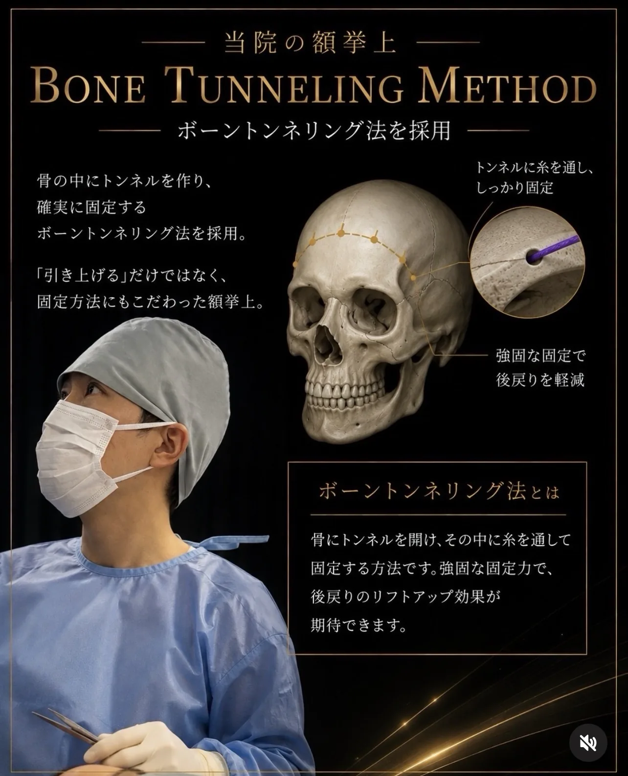 ボーントンネリング法