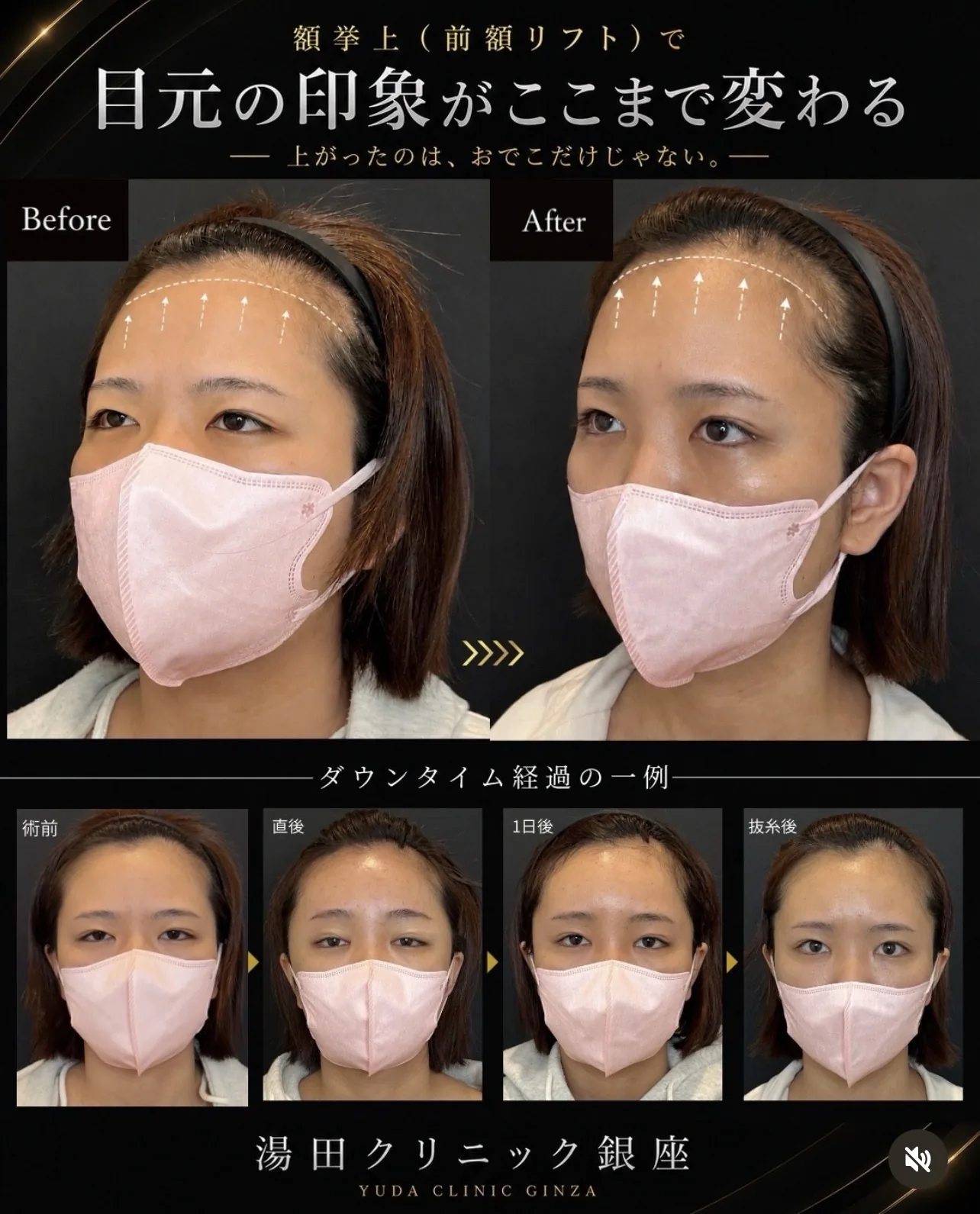 額挙上のBefore Afterとダウンタイム経過