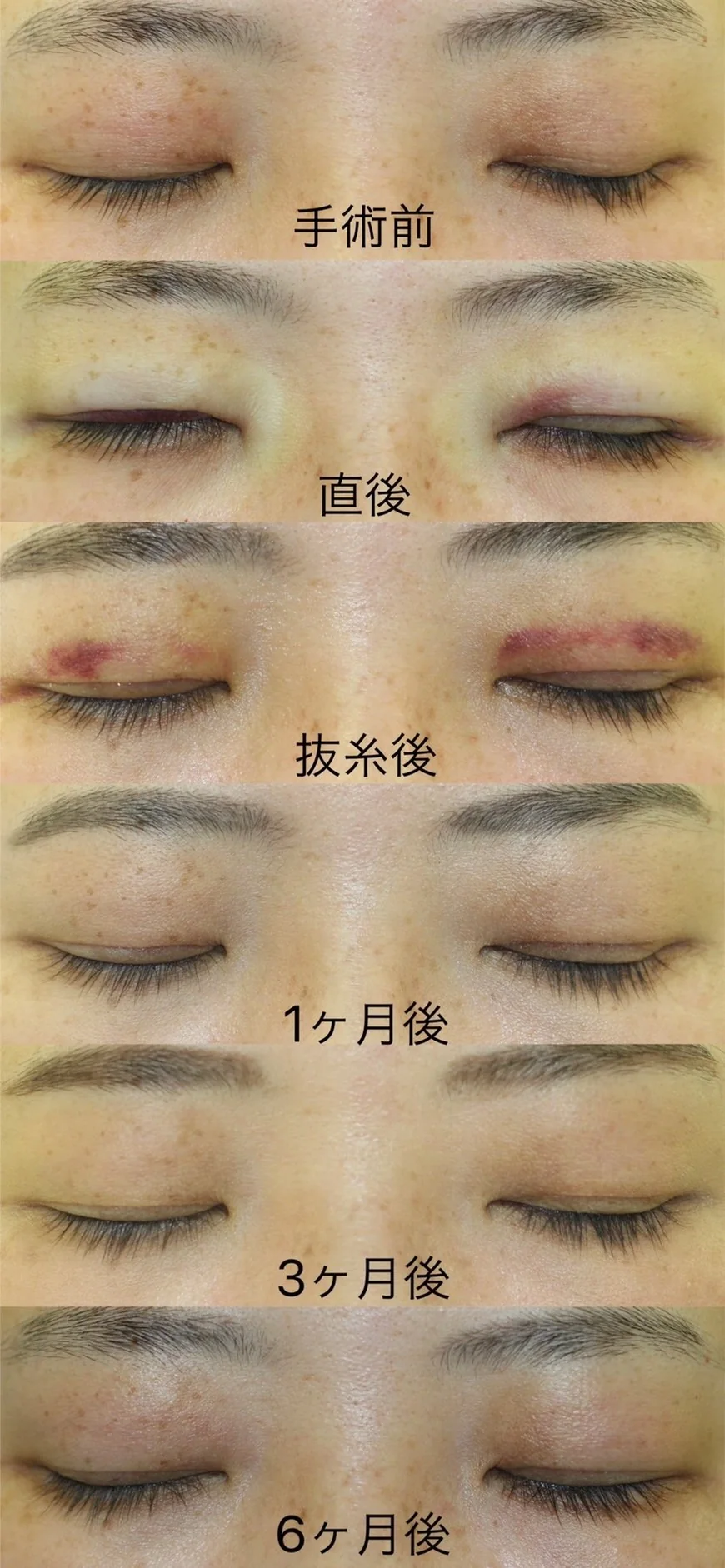 二重切開の術前、直後、抜糸後、1か月、3か月、6か月の閉眼時の赤みの経過