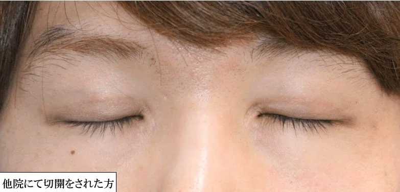 他院で二重切開を受け、閉眼時の傷跡について修正相談に来院した例