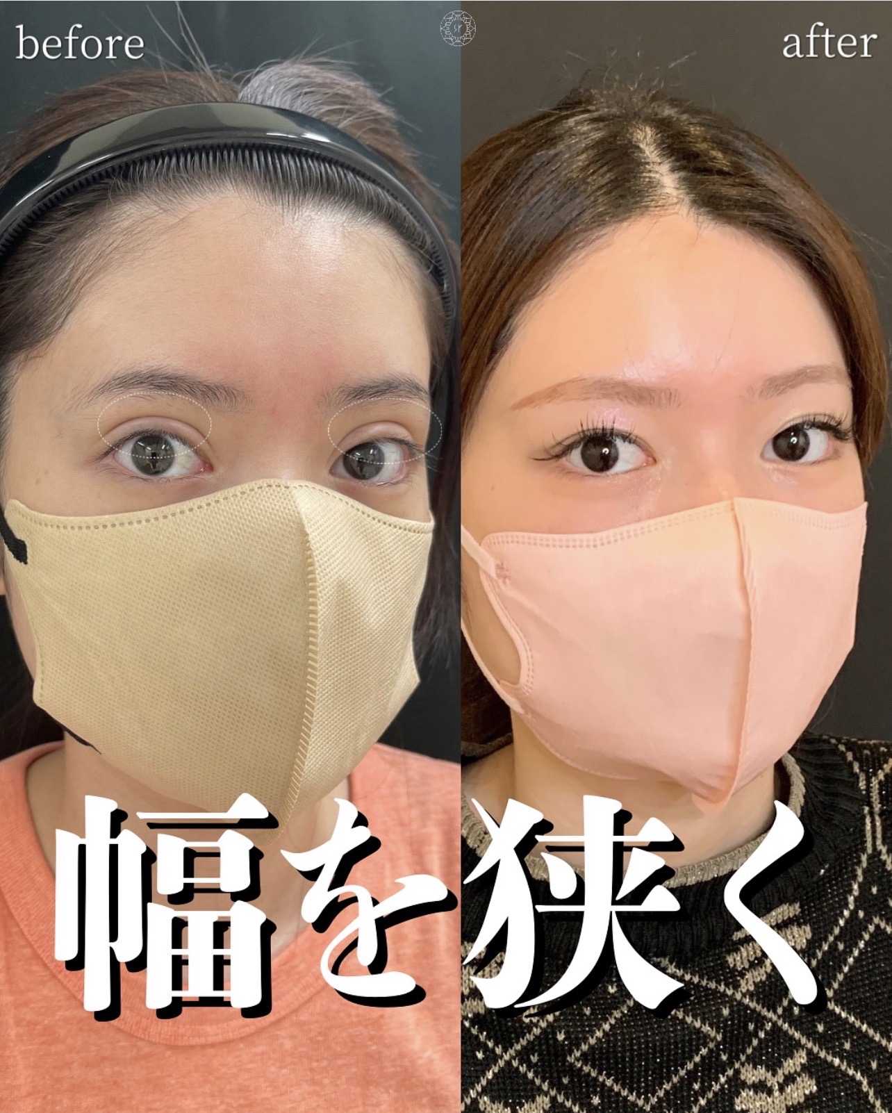 CASE 02 ハム目を修正したい の症例写真