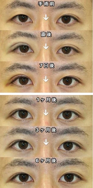 片目だけ二重切開を行った直後から6か月までの経過