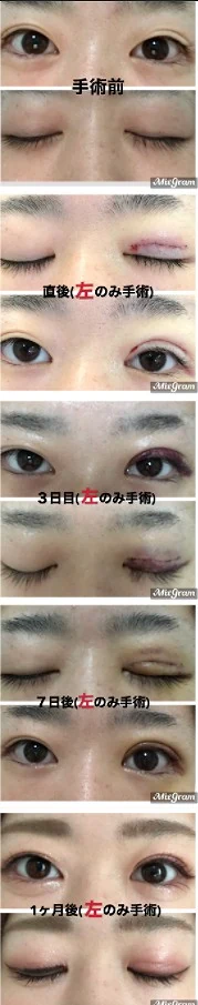 左目を先に二重切開した片目ずつ手術の経過