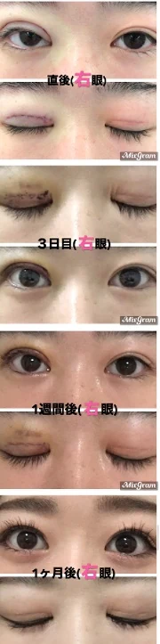 右目を後から二重切開した片目ずつ手術の経過