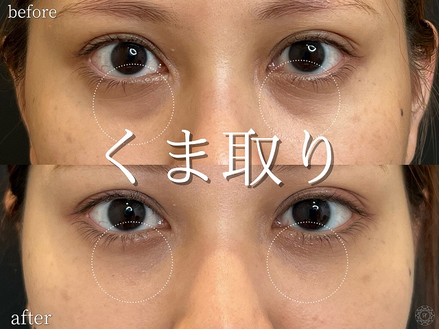 20代女性｜裏ハムラ法の症例写真