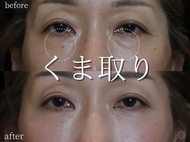 50代女性｜表ハムラ法の症例写真