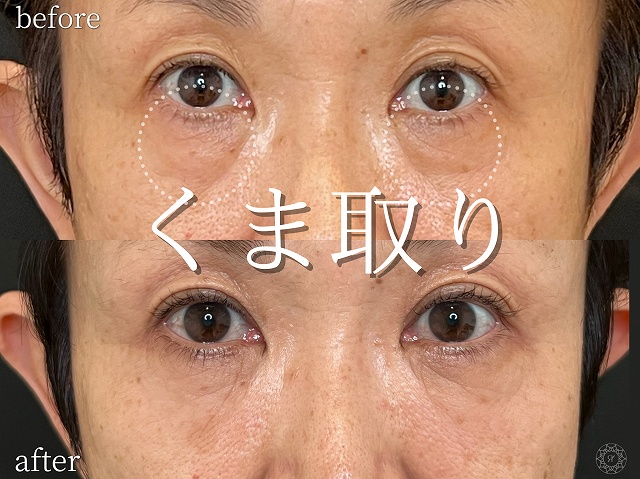 50代女性｜表ハムラ＋ミッドフェイスの症例写真