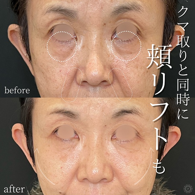 50代女性｜表ハムラ＋ミッドフェイスの比較・経過写真 2