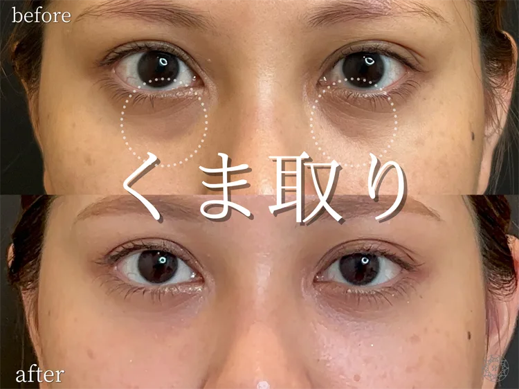 クマ取りの代表症例 Before After