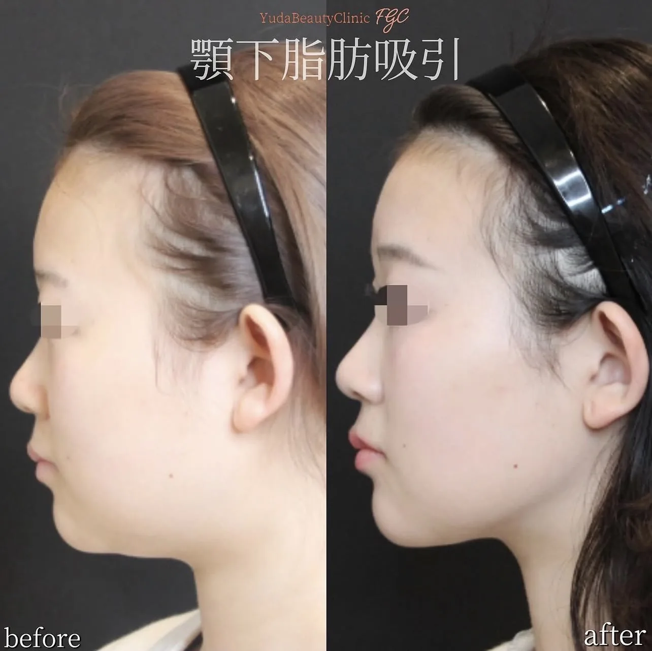 顎下脂肪吸引の代表症例 側面 Before After