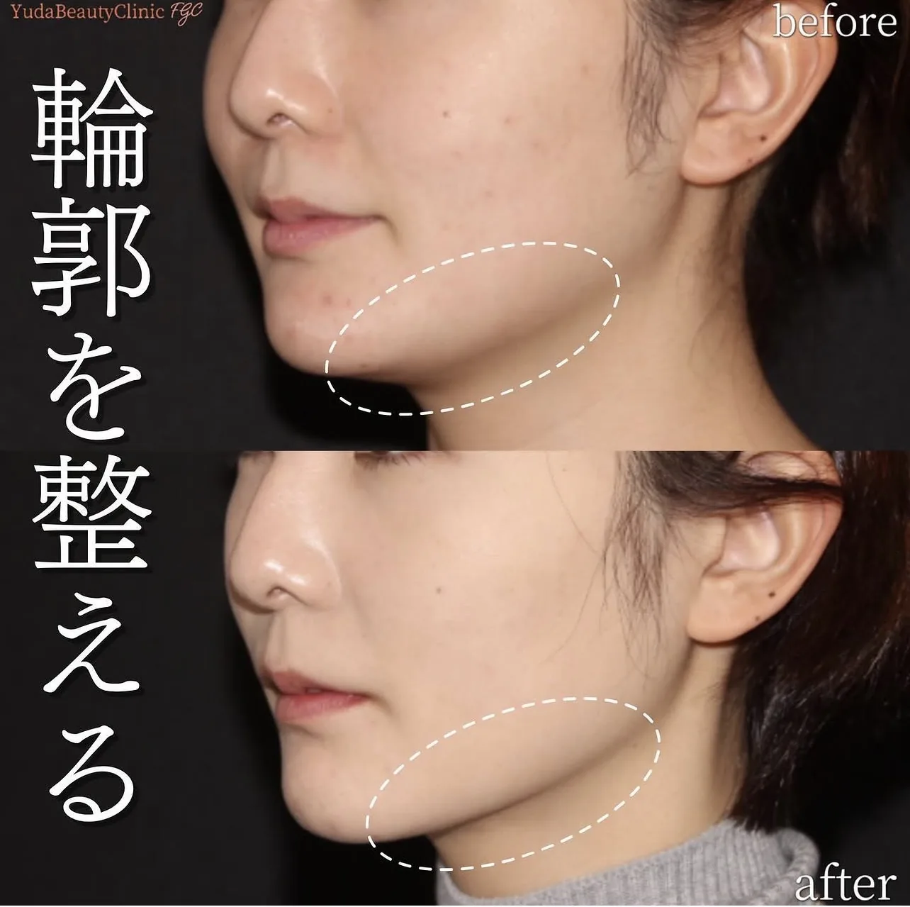 顎下脂肪吸引 症例2 Before After