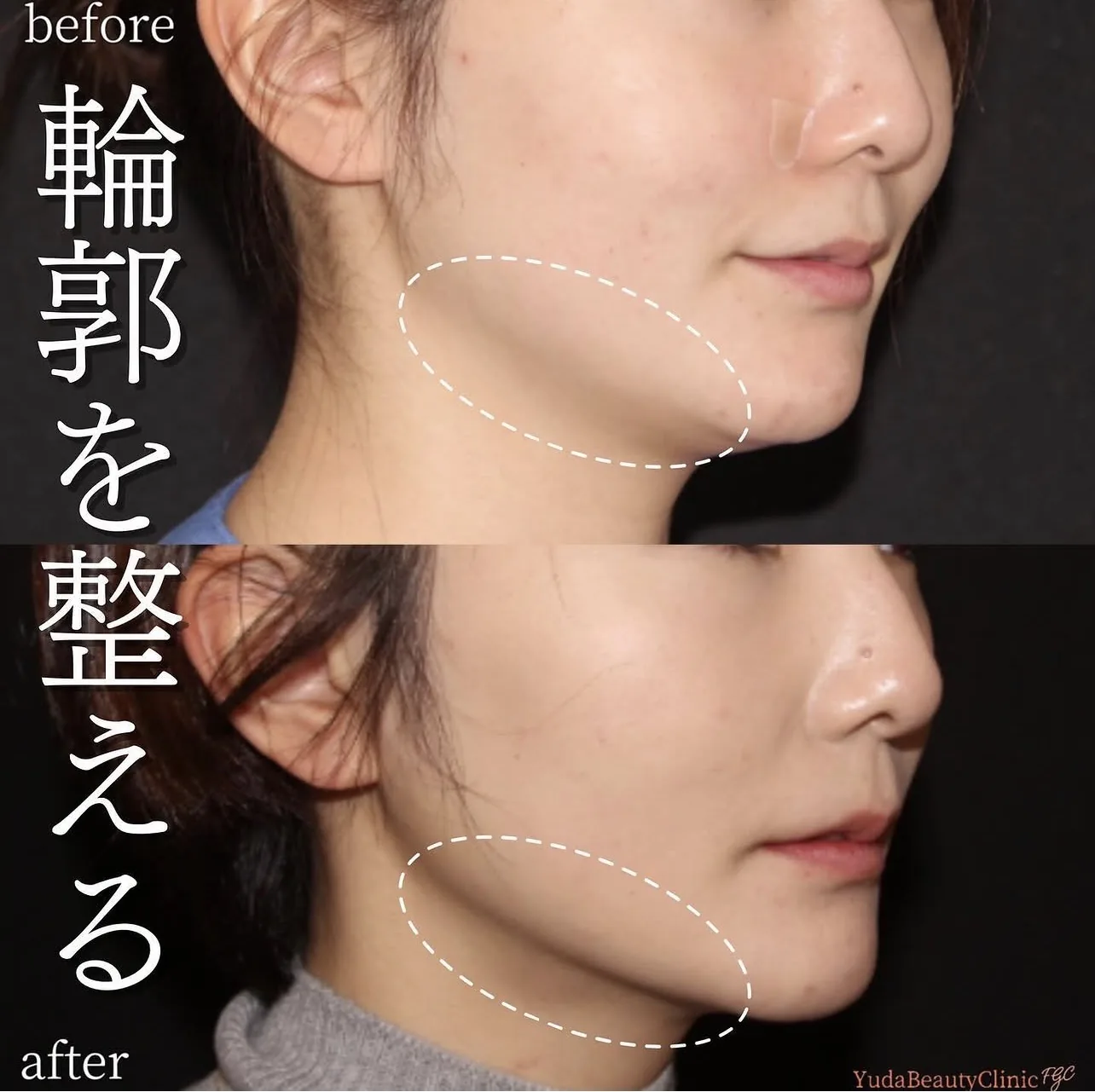 顎下脂肪吸引 症例2 側面 Before After