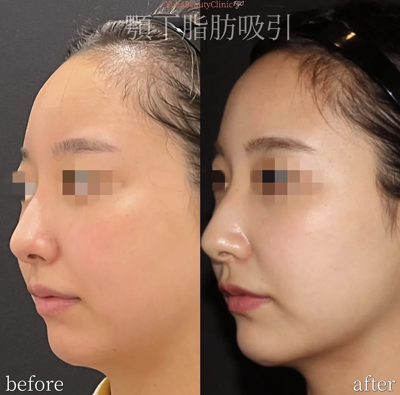 顎下脂肪吸引 症例3 Before After