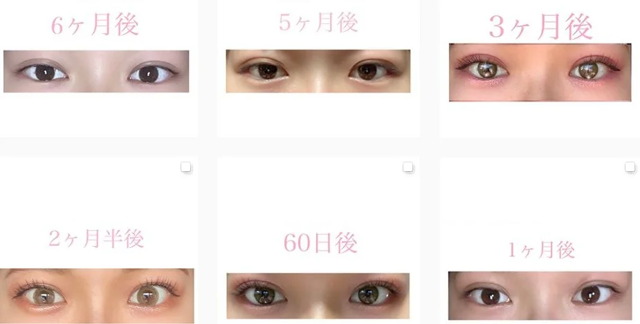 二重埋没法の術後1か月から6か月までの二重ラインの経過