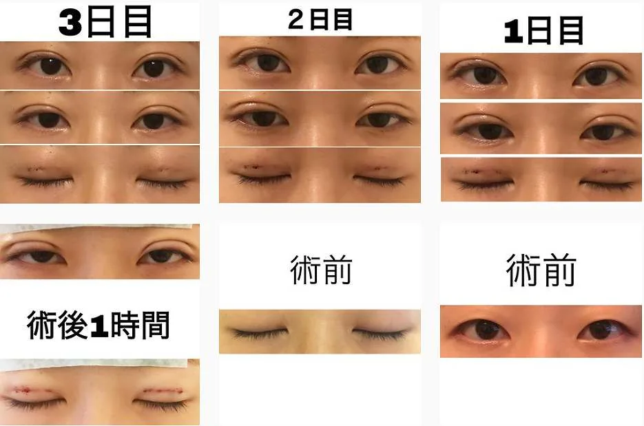 二重埋没法の術前、術後1時間、1日、2日、3日の開眼時と閉眼時の腫れの経過