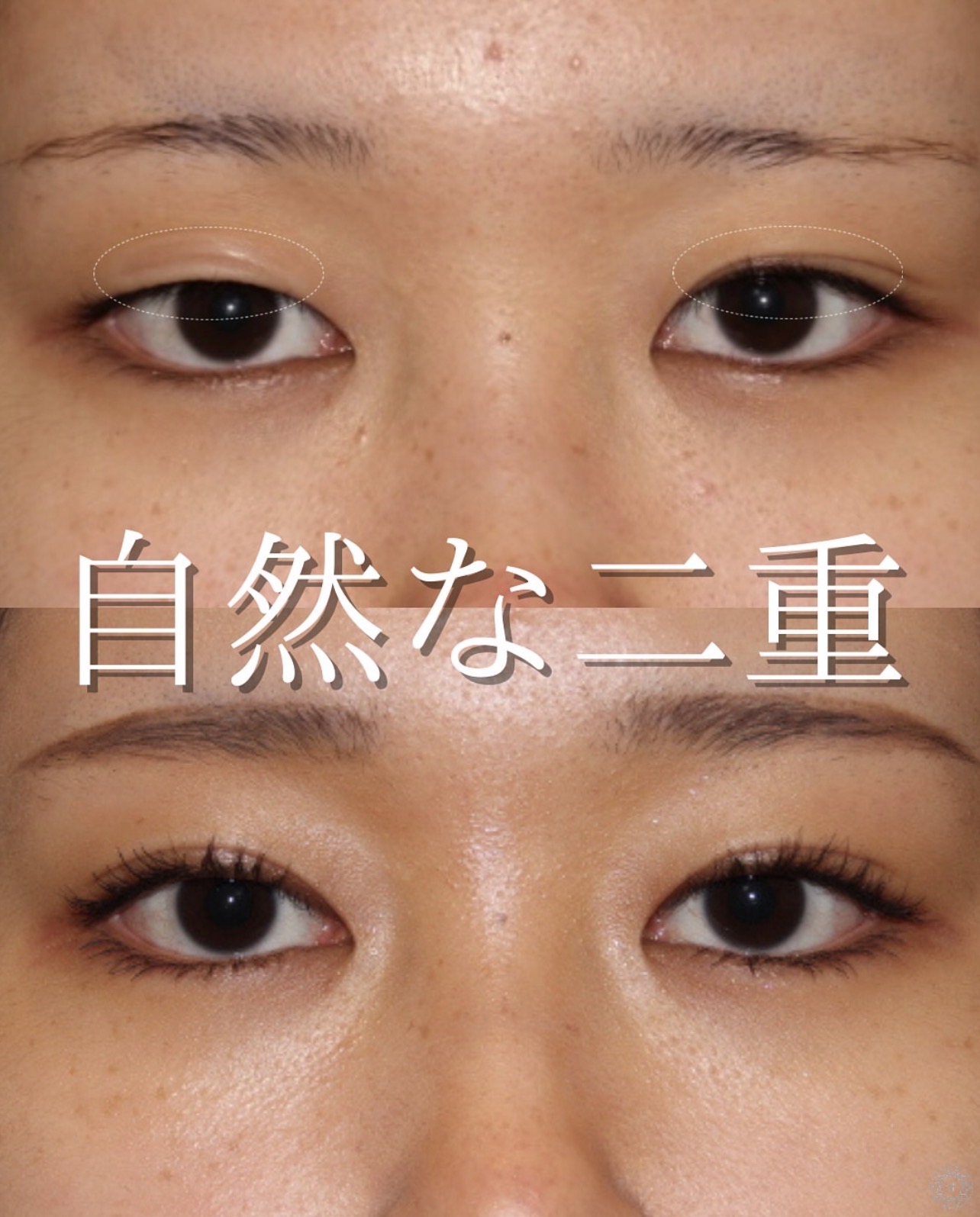 自然な二重ラインに整えた二重切開法の術前と術後3か月