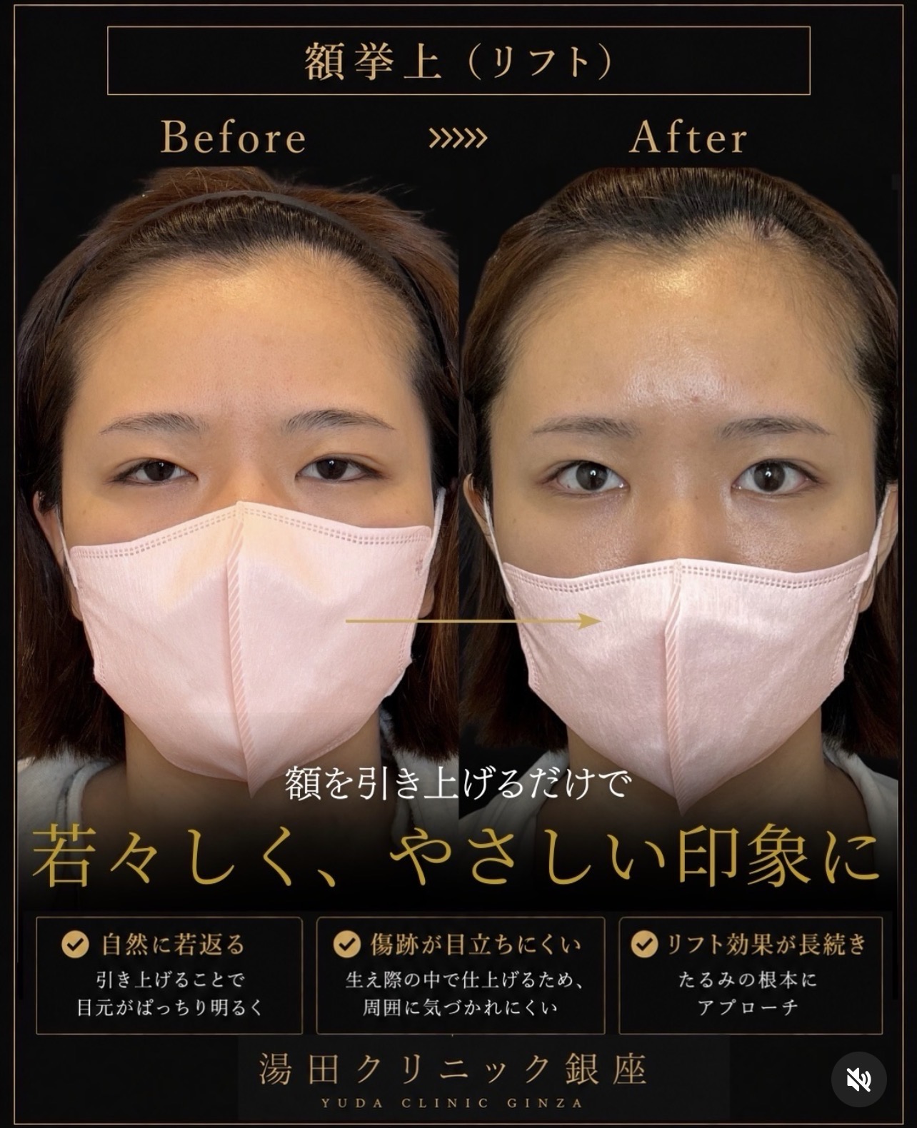 重い目元を、額から見直す