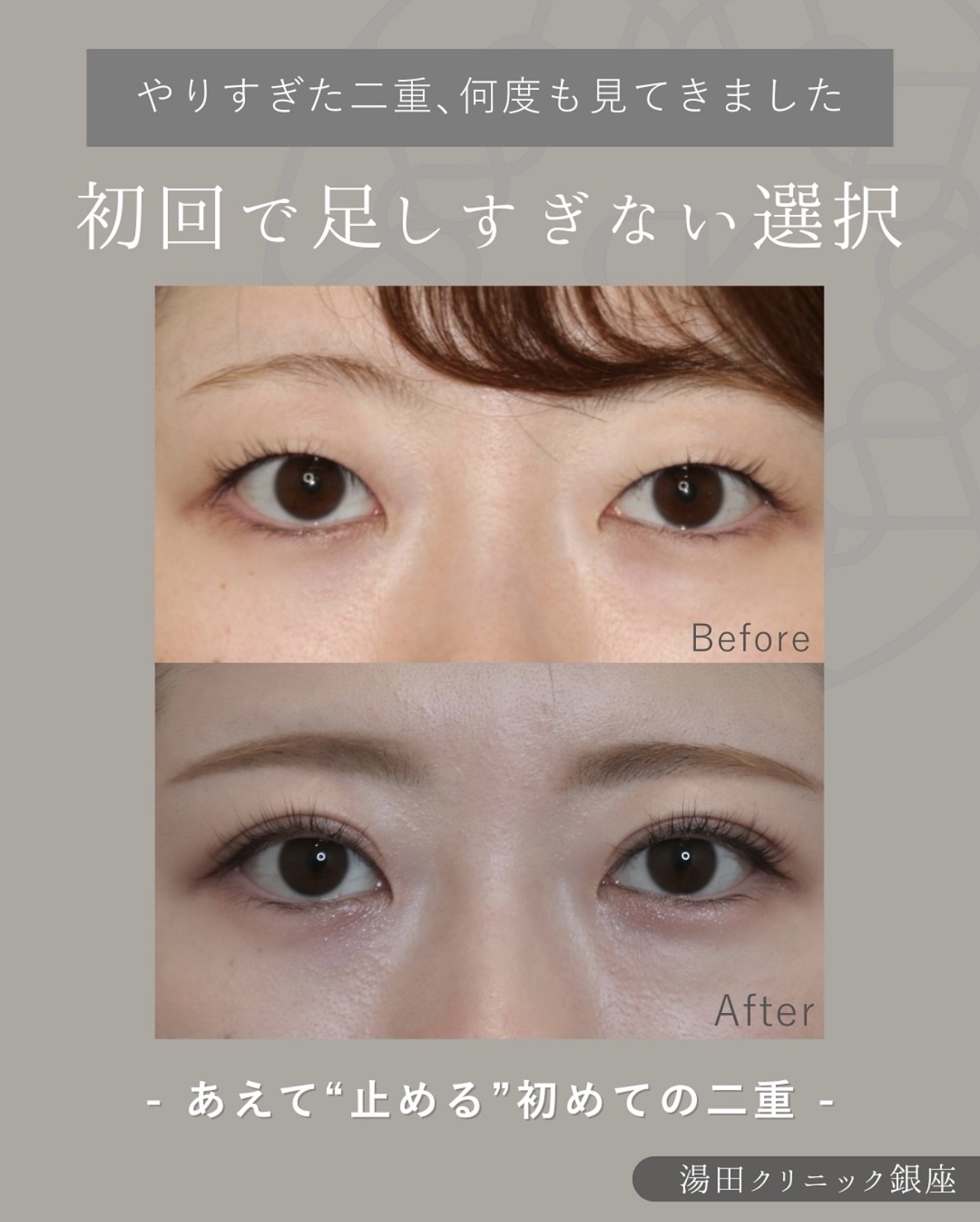 初めての二重整形を、自然な印象に