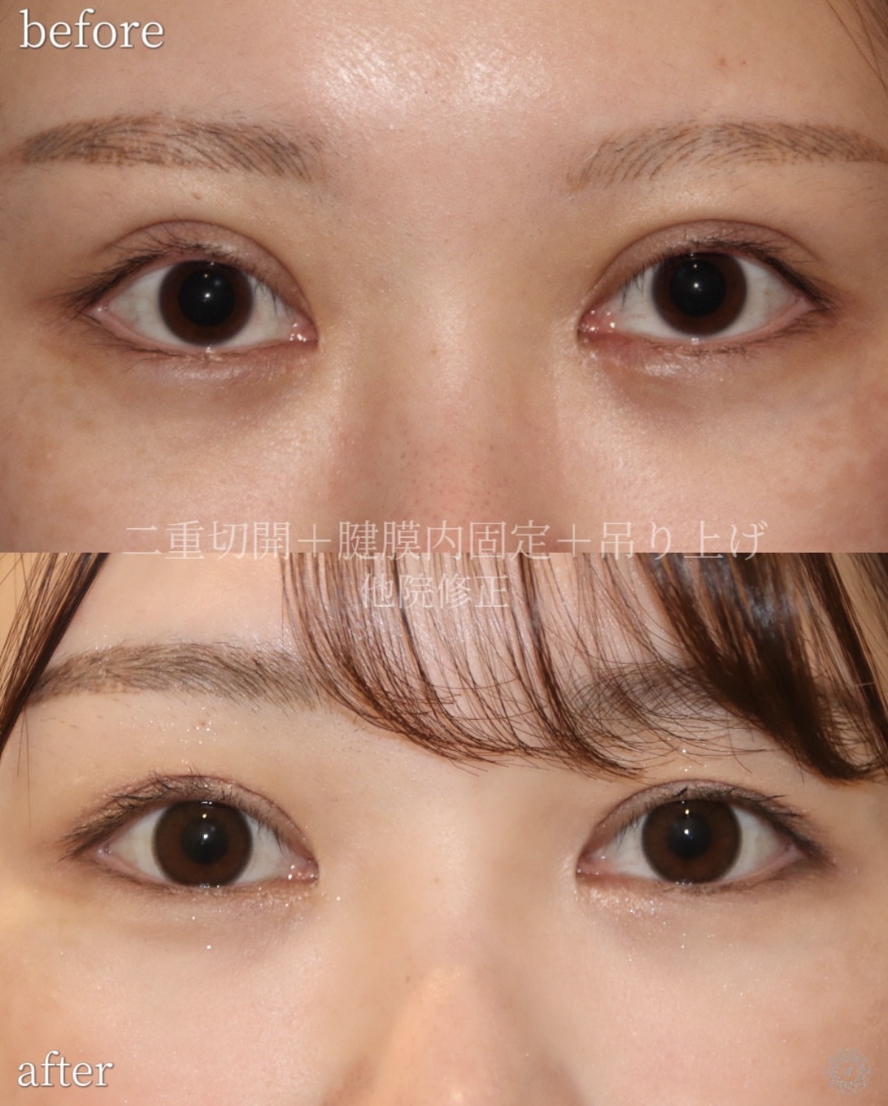 広すぎる二重幅を、自然になじむ幅へ
