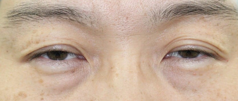 3０代男性眼瞼下垂手術前