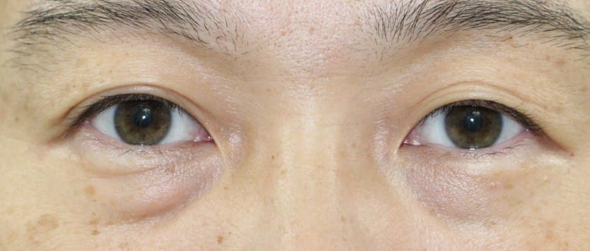 3０代男性眼瞼下垂手術後