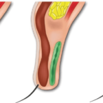 二重切開修正手術の世界の美容整形テクニック「挙筋腱膜上脂肪前転術」