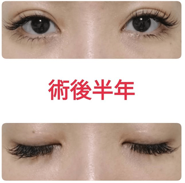 眼瞼下垂 二重切開 目頭切開の症例写真 湯田眼科美容クリニック