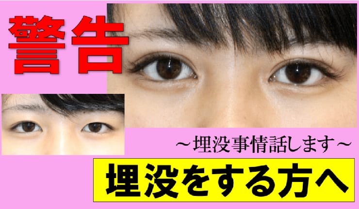 二重整形埋没法の怖いリスクと避けるためのおすすめ方法。（失敗例も）