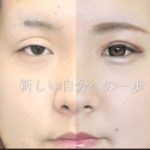 二重切開修正　傷跡とハム目は治せます。