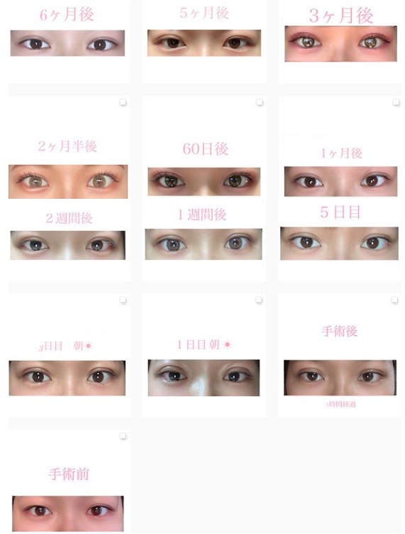 二重整形の経過全部見せます 美容外科医が解説 湯田眼科美容クリニック Ry グループ