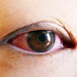 二重整形後に三重になることはあるのか？解決法まで美容外科医湯田が解説。