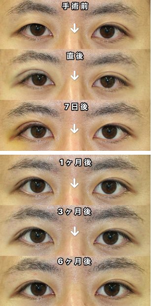 二重整形を片目ずつ もしくは片目だけやることは可能なのか 美容外科医湯田が詳説します 湯田眼科美容クリニック Ry グループ